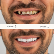 SMILEFIT PRO – ΡΥΘΜΙΖΟΜΕΝΟ ΣΕΤ ΔΟΝΤΙΩΝ ΓΙΑ ΤΕΛΕΙΟ ΧΑΜΟΓΕΛΟ
