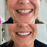SMILEFIT PRO – ΡΥΘΜΙΖΟΜΕΝΟ ΣΕΤ ΔΟΝΤΙΩΝ ΓΙΑ ΤΕΛΕΙΟ ΧΑΜΟΓΕΛΟ